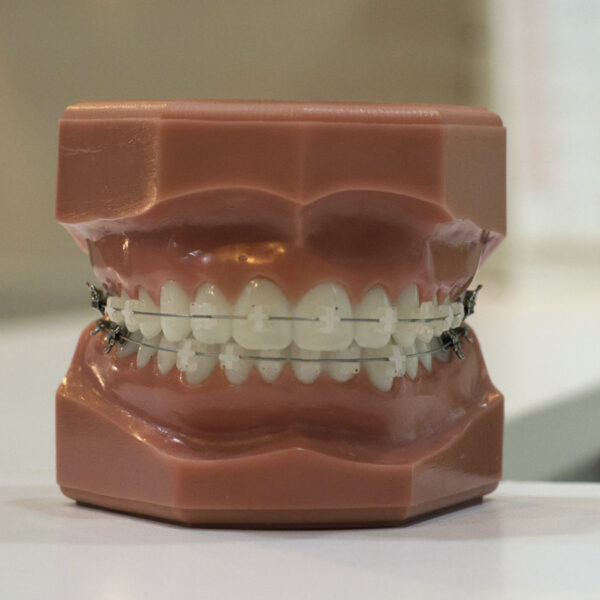 Qué hacer si te duelen los brackets